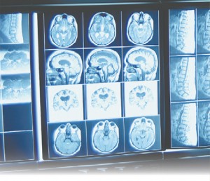 brain scans, brain x-ray's, brain images