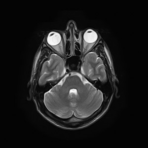 Brain scan, brain x-ray, brain image, brain damage, traumatic brain injury
