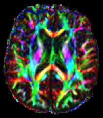 DTI Scans Diagnose Hidden Brain Injuries