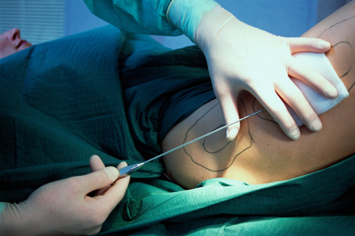 Malpractice and Wrongful Death Suits in Plastic Surgery